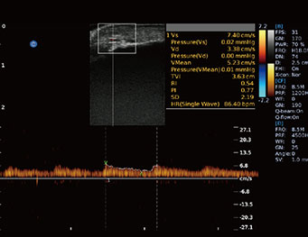 ArtiVAso de ponta, modo pw ebit50