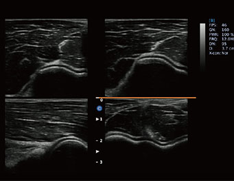 Articulação do cootvelo, modo 4B ebit50