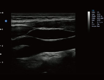 CCA, ICA, ECA, modo bebit50