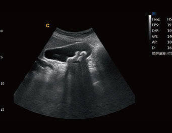 Cálculo na vesícula biliar, modo b ebit50