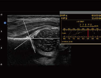 Enxeto de quadril, ebit50